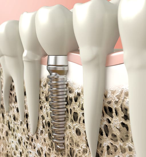 Dental Implants, Legacy Dental, Lethbridge Dentist