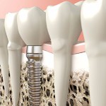 Dental Implants, Lethbridge Dentist